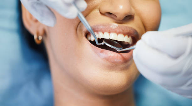 Best Emergency Dentist for Lost Fillings or Crowns in Bessemer, MI
