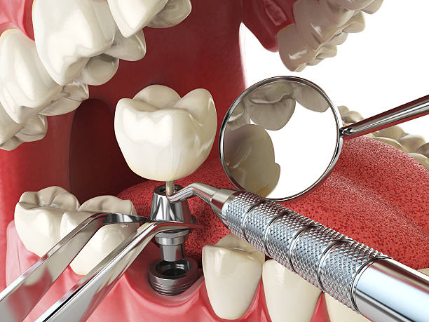 Best Emergency Dentist for Lost Fillings or Crowns in Bessemer, MI
